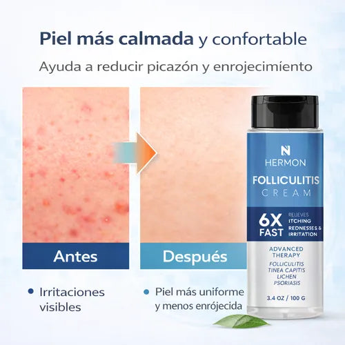 FOLLICULITIS CREAM antes y después