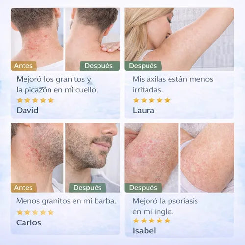 FOLLICULITIS CREAM comparación