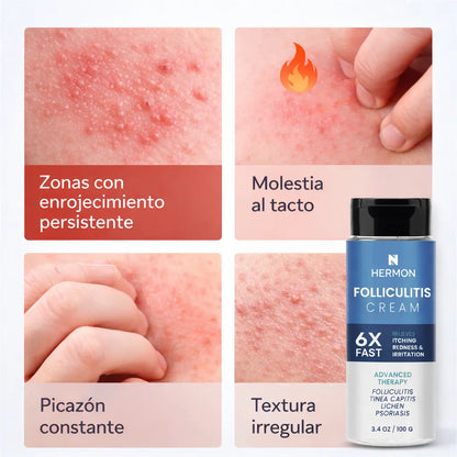 FOLLICULITIS CREAM