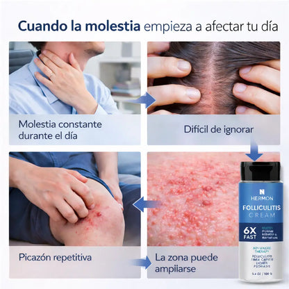 FOLLICULITIS CREAM